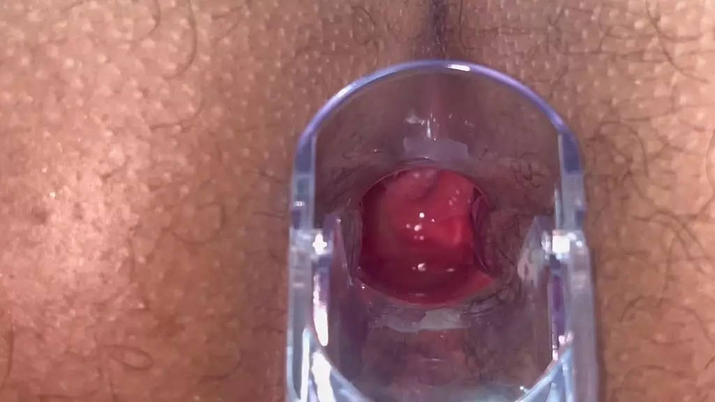 speculum anal vision